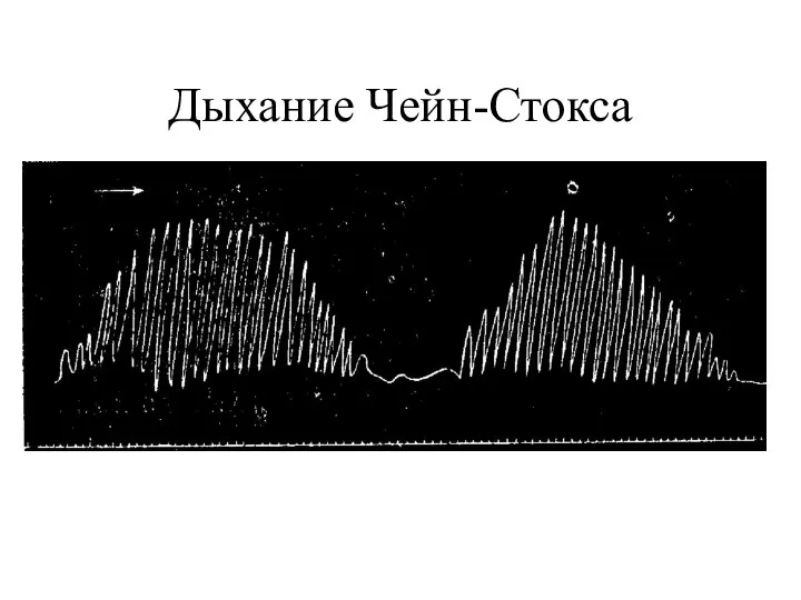 Дыхание Чейн-Стокса