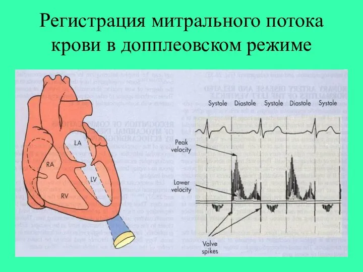 Регистрация митрального потока крови в допплеовском режиме