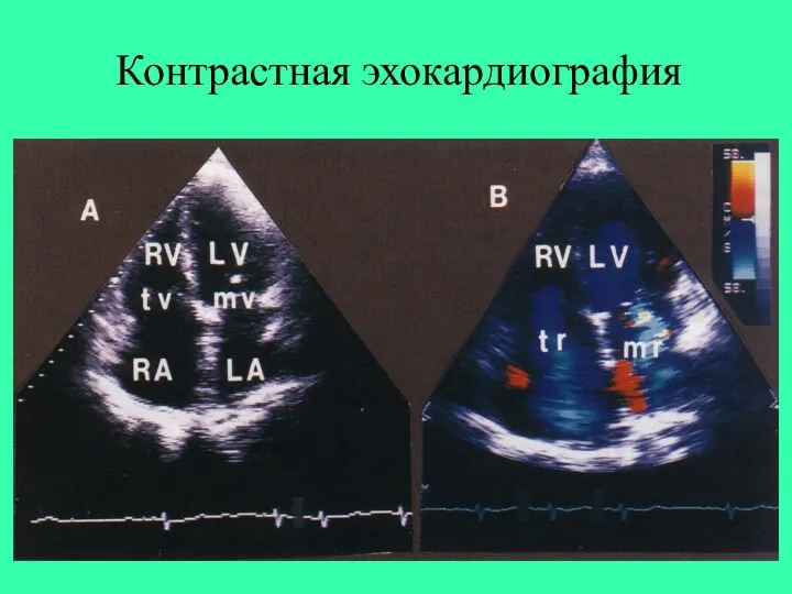 Контрастная эхокардиография