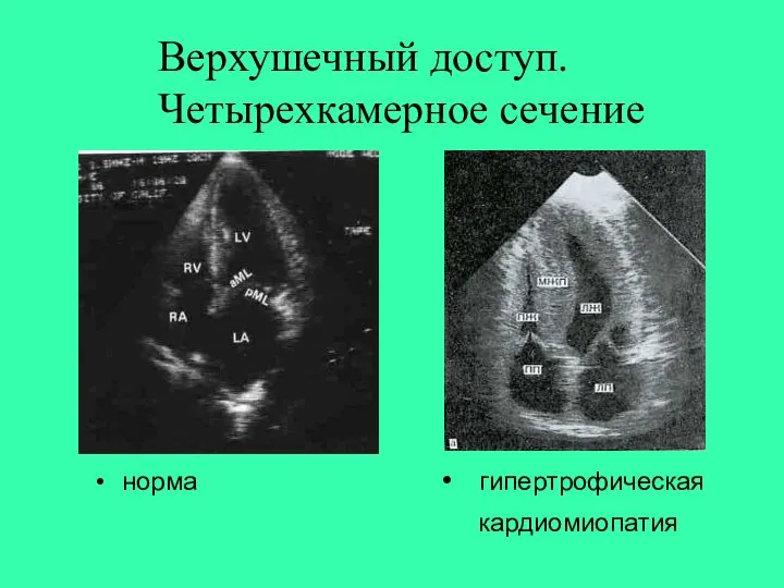 Верхушечный доступ. Четырехкамерное сечение норма • гипертрофическая кардиомиопатия