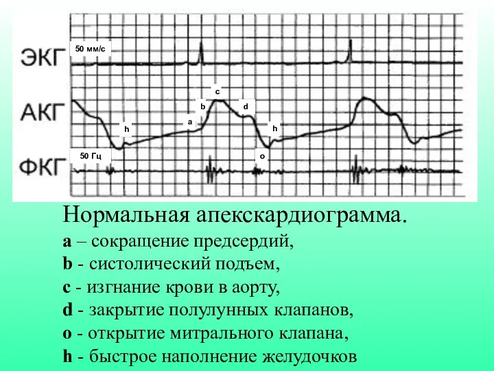 Нормальная апекскардиограмма. а – сокращение предсердий, b - cистолический подъем, с