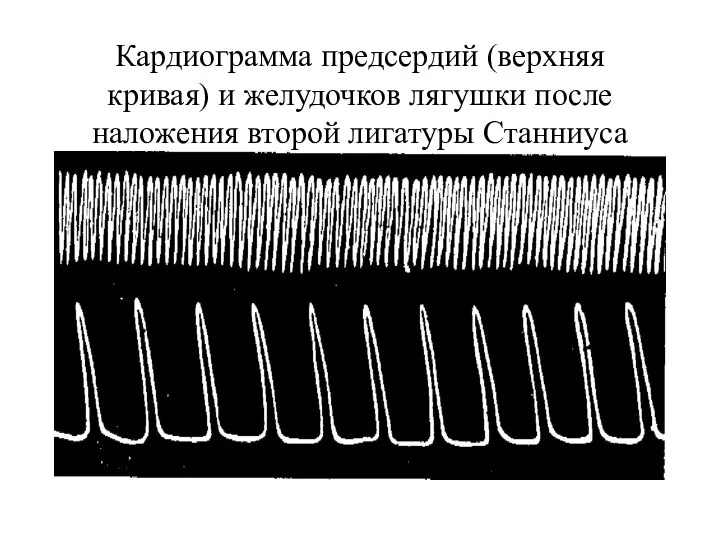 Кардиограмма предсердий (верхняя кривая) и желудочков лягушки после наложения второй лигатуры Станниуса