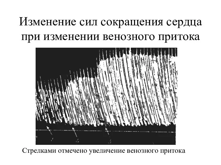 Изменение сил сокращения сердца при изменении венозного притока Стрелками отмечено увеличение венозного притока