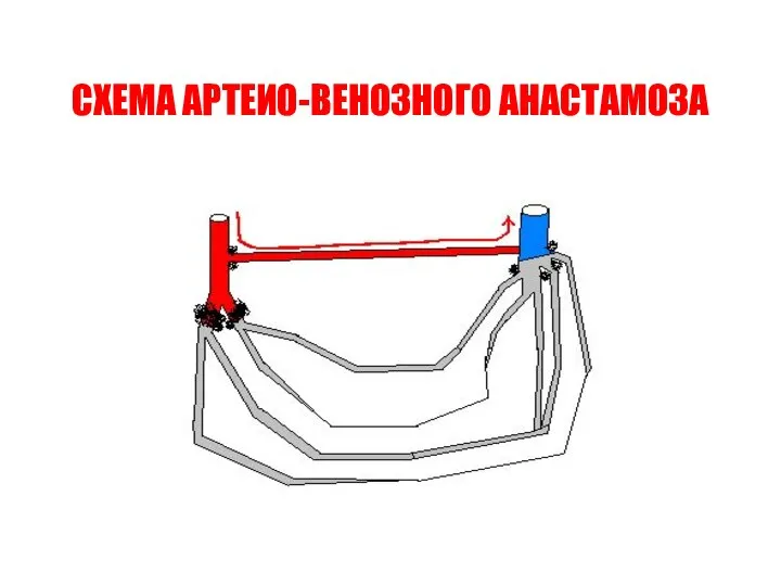 СХЕМА АРТЕИО-ВЕНОЗНОГО АНАСТАМОЗА