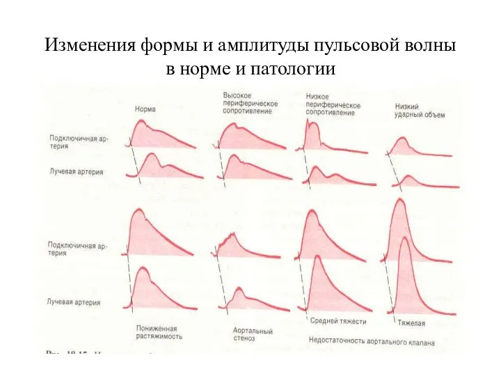 Изменения формы и амплитуды пульсовой волны в норме и патологии