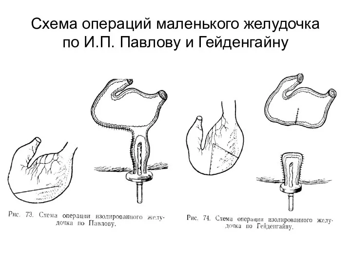 Схема операций маленького желудочка по И.П. Павлову и Гейденгайну