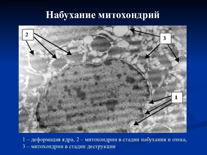 Набухание митохондрий 1 – деформация ядра, 2 – митохондрии в стадии