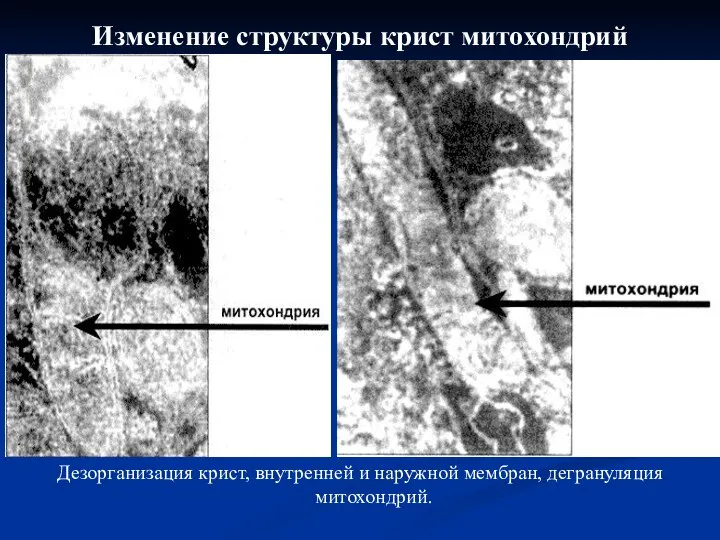 Изменение структуры крист митохондрий Дезорганизация крист, внутренней и наружной мембран, дегрануляция митохондрий.