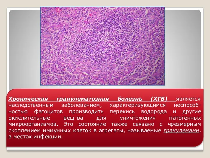 Хроническая гранулематозная болезнь (ХГБ) является наследственным заболеванием, характеризующимся неспособ-ностью фагоцитов производить