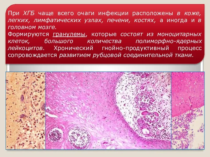 При ХГБ чаще всего очаги инфекции расположены в коже, легких, лимфатических