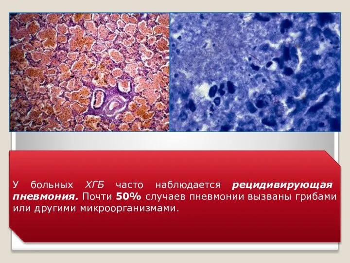У больных ХГБ часто наблюдается рецидивирующая пневмония. Почти 50% случаев пневмонии вызваны грибами или другими микроорганизмами.
