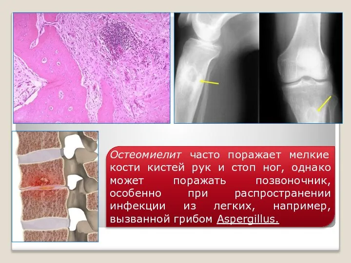 Остеомиелит часто поражает мелкие кости кистей рук и стоп ног, однако