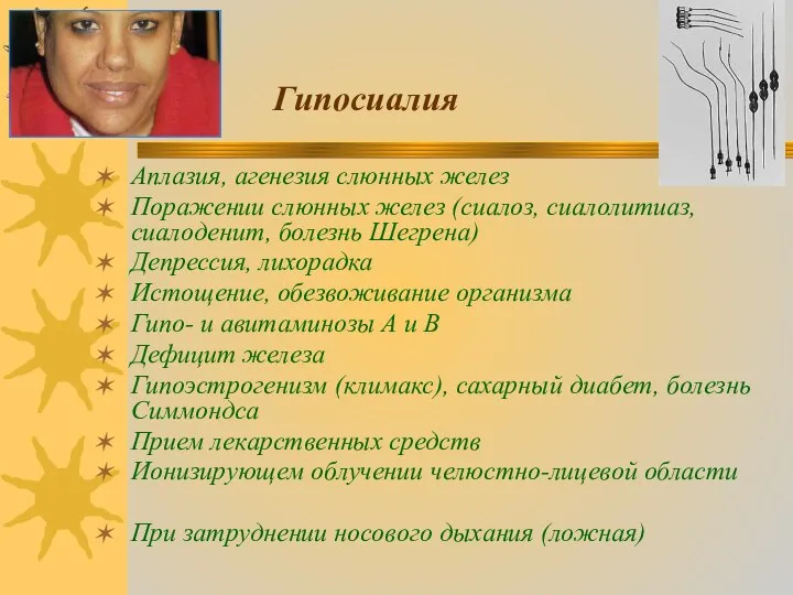 Гипосиалия Аплазия, агенезия слюнных желез Поражении слюнных желез (сиалоз, сиалолитиаз, сиалоденит,