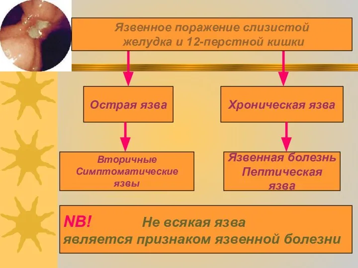 Острая язва Хроническая язва Вторичные Симптоматические язвы Язвенная болезнь Пептическая язва