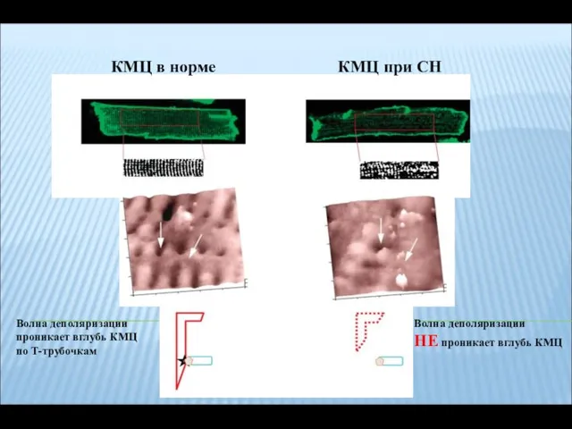 КМЦ в норме КМЦ при СН Волна деполяризации проникает вглубь КМЦ