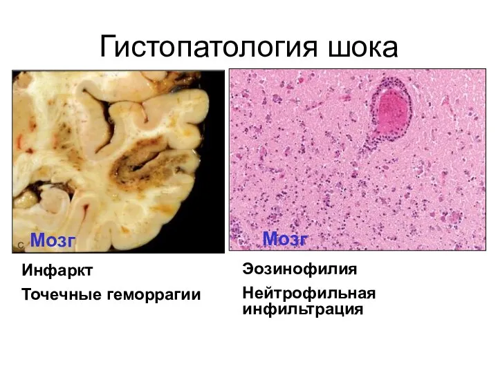 Гистопатология шока