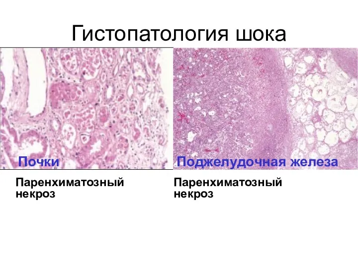 Гистопатология шока