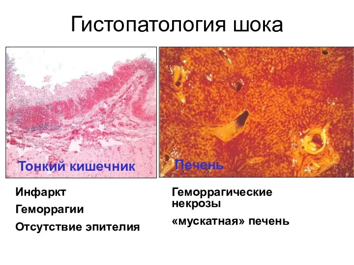 Гистопатология шока