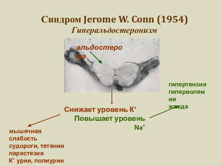 Синдром Jerome W. Conn (1954) Гиперальдостеронизм альдостерома Снижает уровень К+ Повышает