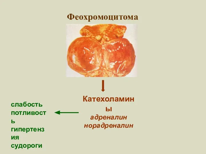 Феохромоцитома Катехоламины адреналин норадреналин слабость потливость гипертензия судороги