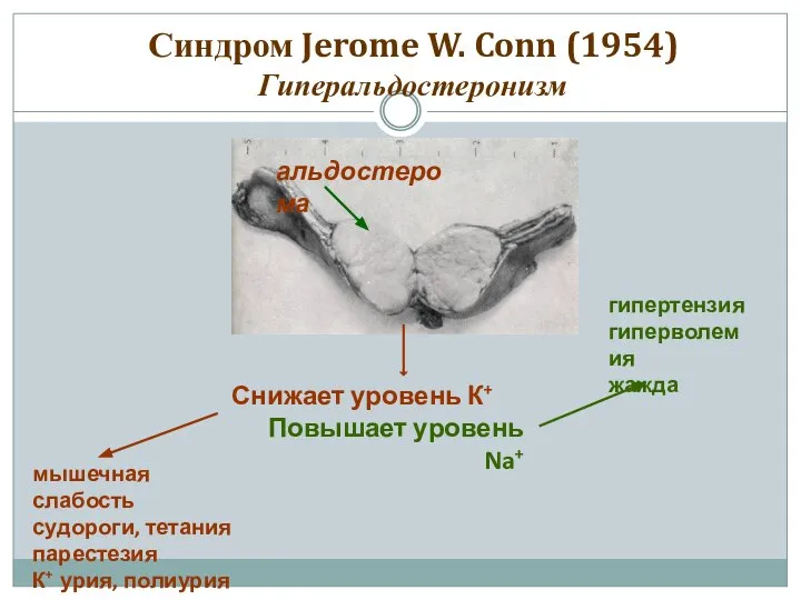 Синдром Jerome W. Conn (1954) Гиперальдостеронизм альдостерома Снижает уровень К+ Повышает