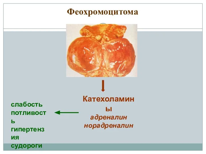 Феохромоцитома Катехоламины адреналин норадреналин слабость потливость гипертензия судороги