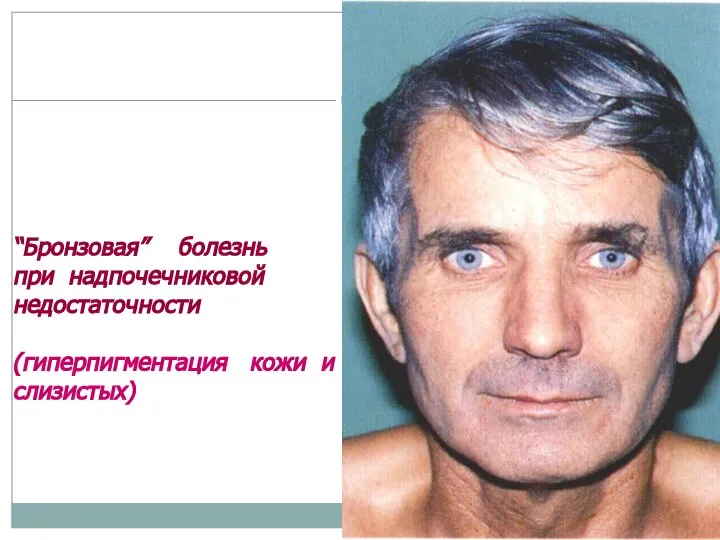 “Бронзовая” болезнь при надпочечниковой недостаточности (гиперпигментация кожи и слизистых)