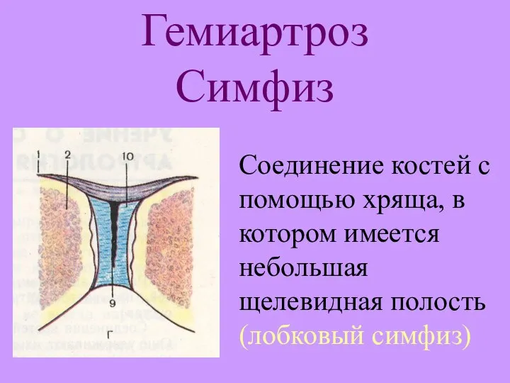 Гемиартроз Симфиз Соединение костей с помощью хряща, в котором имеется небольшая щелевидная полость (лобковый симфиз)
