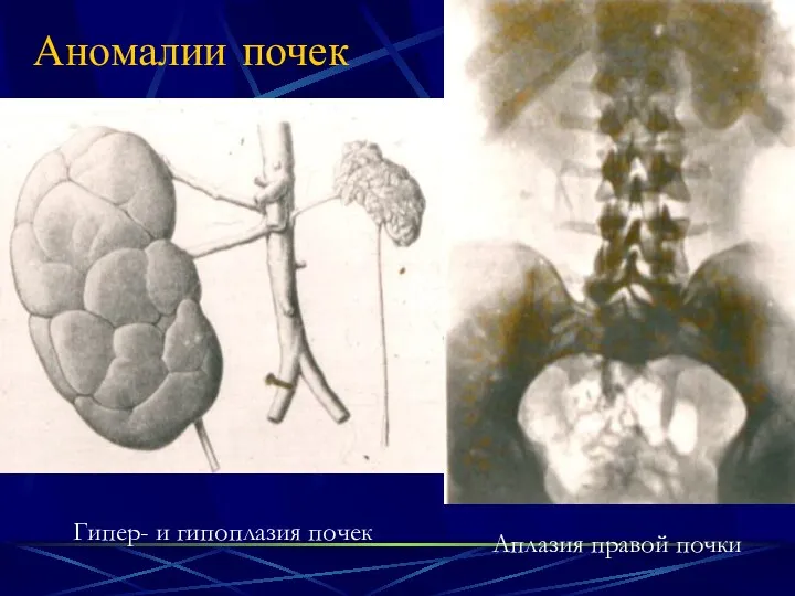 Аномалии почек Гипер- и гипоплазия почек Аплазия правой почки