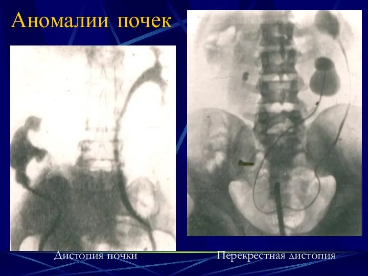 Аномалии почек Дистопия почки Перекрестная дистопия