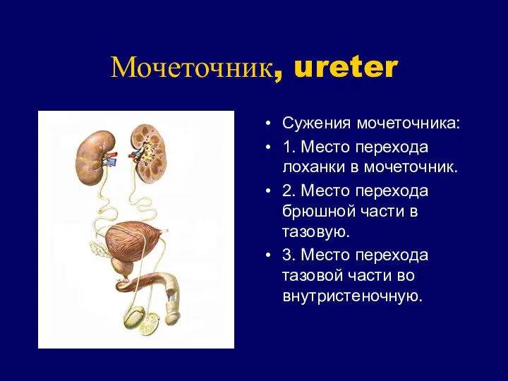 Мочеточник, ureter Сужения мочеточника: 1. Место перехода лоханки в мочеточник. 2.