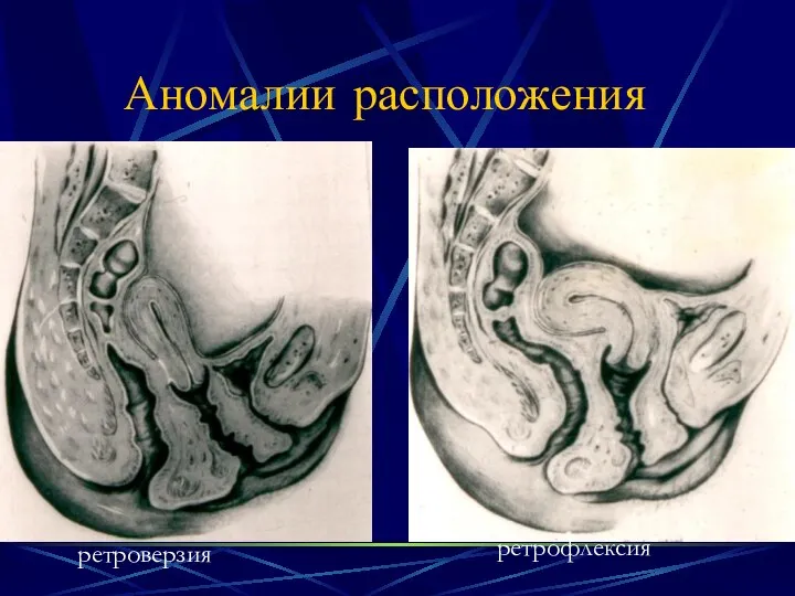 Аномалии расположения ретроверзия ретрофлексия