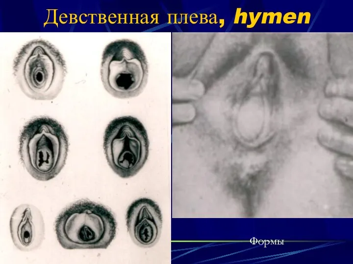 Девственная плева, hymen Формы