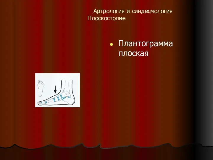 Артрология и синдесмология Плоскостопие Плантограмма плоская