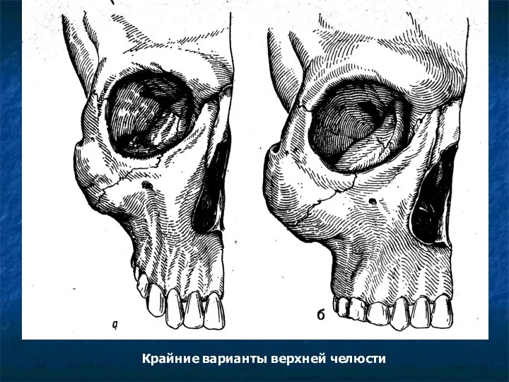 Крайние варианты верхней челюсти