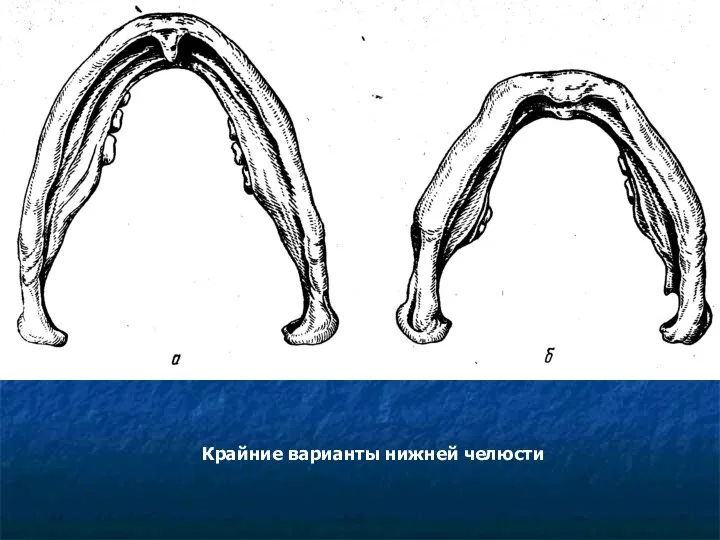 Крайние варианты нижней челюсти