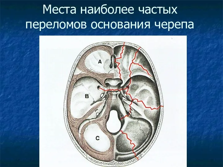 Места наиболее частых переломов основания черепа