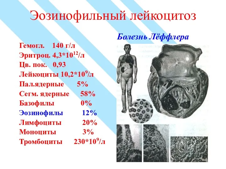 Эозинофильный лейкоцитоз Гемогл. 140 г/л Эритроц. 4,3*1012/л Цв. пок. 0,93 Лейкоциты