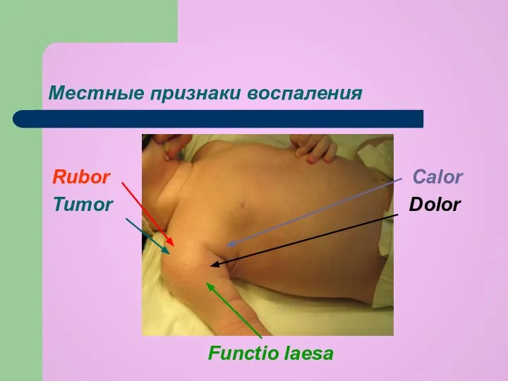 Местные признаки воспаления Rubor Calor Tumor Dolor Functio laesa