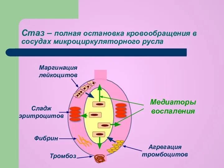 Стаз – полная остановка кровообращения в сосудах микроциркуляторного русла Маргинация лейкоцитов