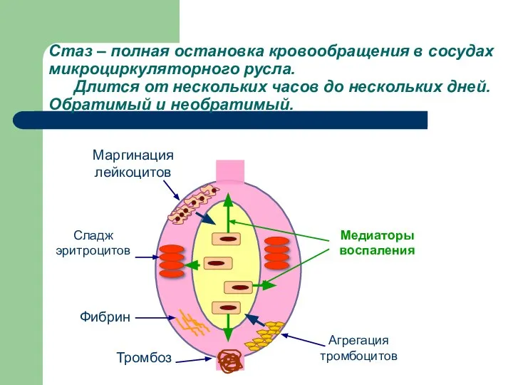 Стаз – полная остановка кровообращения в сосудах микроциркуляторного русла. Длится от