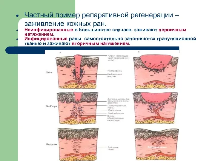 Частный пример репаративной регенерации – заживление кожных ран. Неинфицированные в большинстве