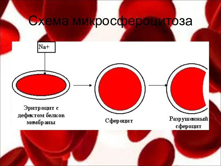 Схема микросфероцитоза