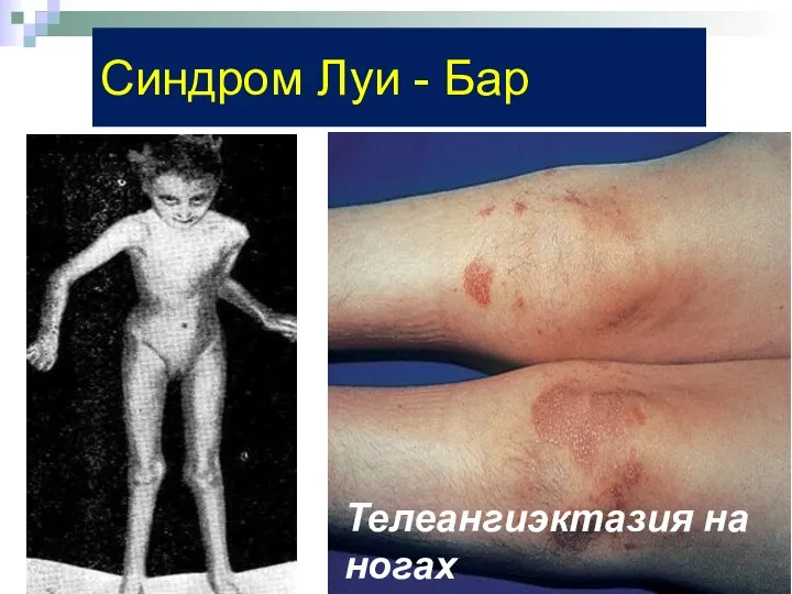 Синдром Луи - Бар Телеангиэктазия на ногах