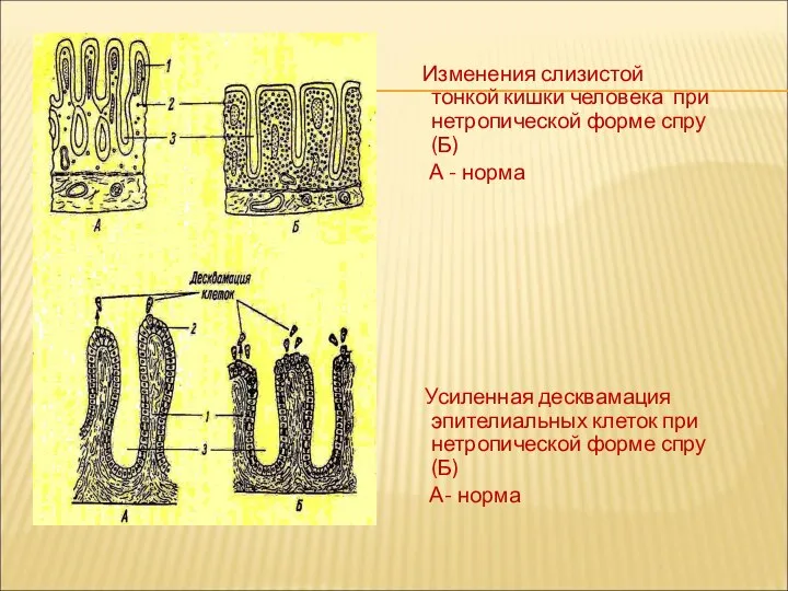 Изменения слизистой тонкой кишки человека при нетропической форме спру (Б) А