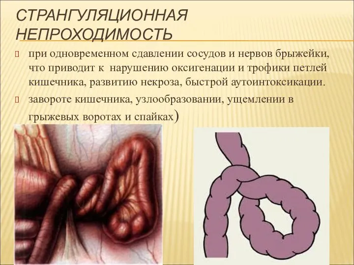 СТРАНГУЛЯЦИОННАЯ НЕПРОХОДИМОСТЬ при одновременном сдавлении сосудов и нервов брыжейки, что приводит