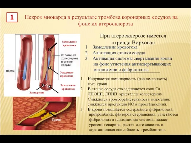 Некроз миокарда в результате тромбоза коронарных сосудов на фоне их атеросклероза