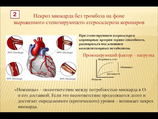 Некроз миокарда без тромбоза на фоне выраженного стенозирующего атеросклероза коронаров 2