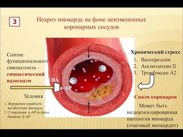 Некроз миокарда на фоне неизмененных коронарных сосудов 3 α-АР Снятие функционального