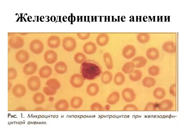 Железодефицитные анемии